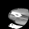 SPORK, NICO - 22.03.1976 - 02.08.2022 - CT obere Extremität - 17:51:17